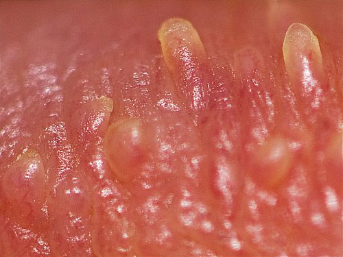 Pearly penile papules on glans