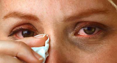 Congestion and watering of eyes are common symptoms.
