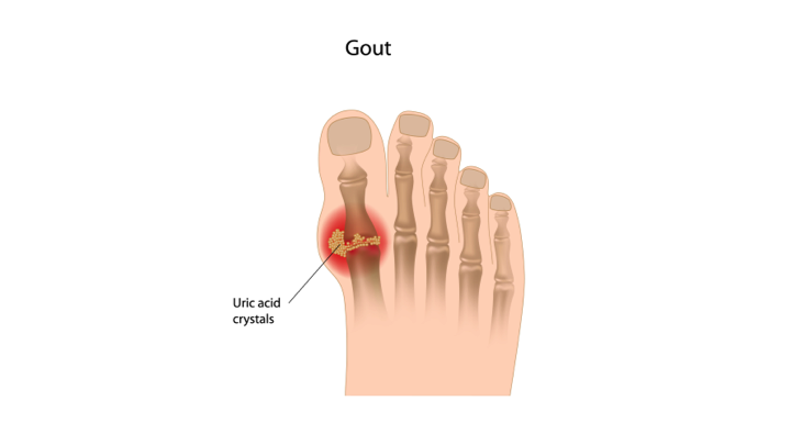 Meaning gout