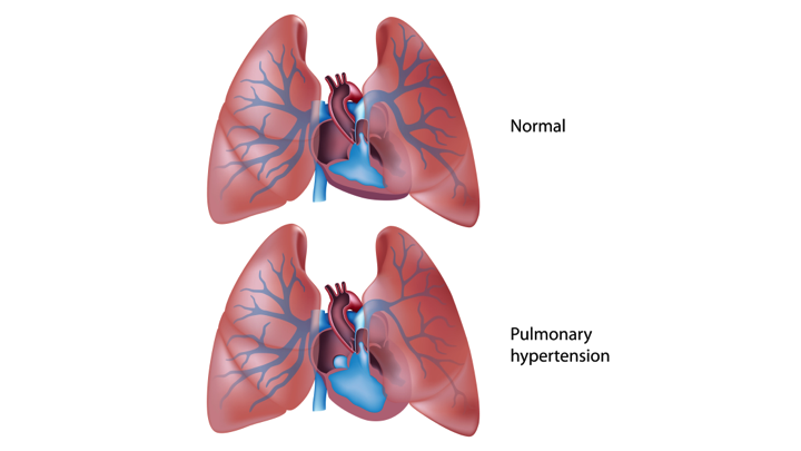 Pulmonary Hypertension Ph