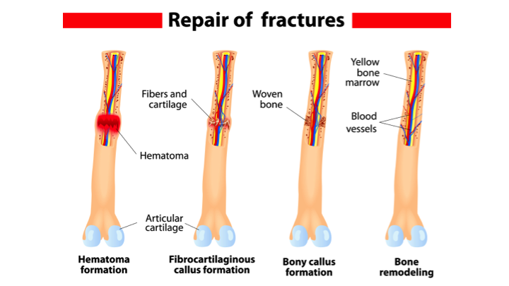 Image result for fracture repair