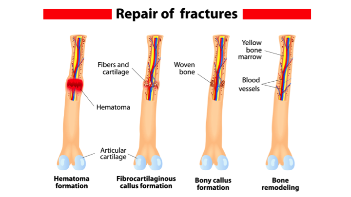 closed fracture vs open fracture