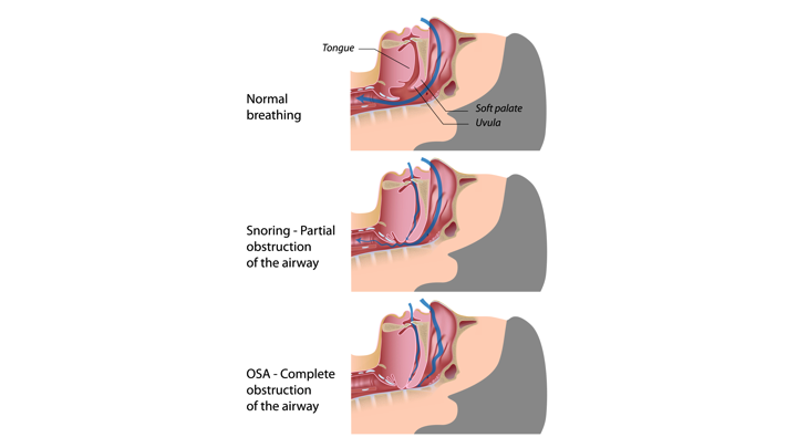 Sleep Apnea