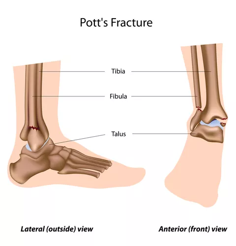 Ankle Fracture - DoveMed