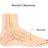 Illustration of Morton's neuroma.