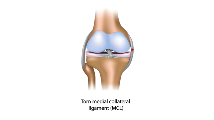 MCL Injury, Medial Collateral Ligament