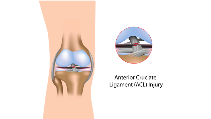 Anterior Cruciate Ligament (ACL) Injury - DoveMed