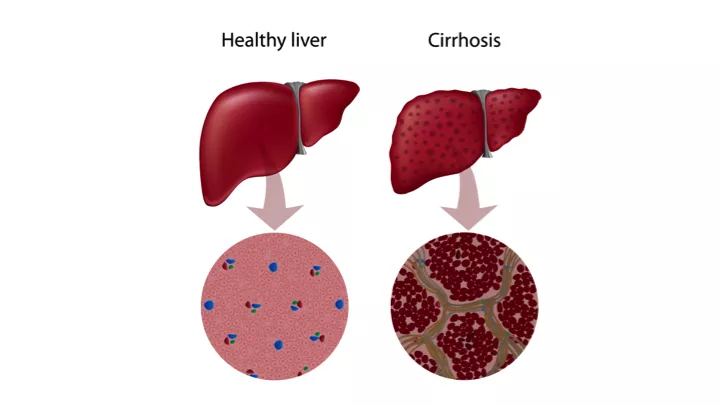 Liver Cirrhosis - DoveMed