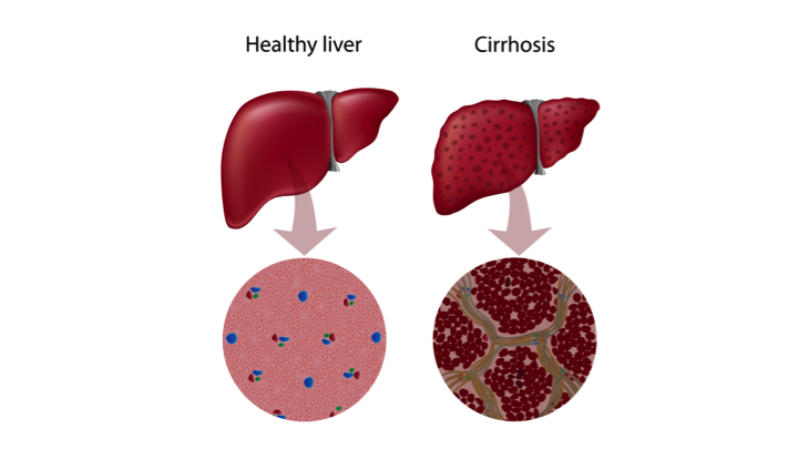 liver-cirrhosis