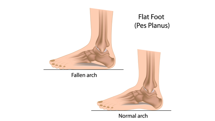 Adult (Acquired) Flatfoot