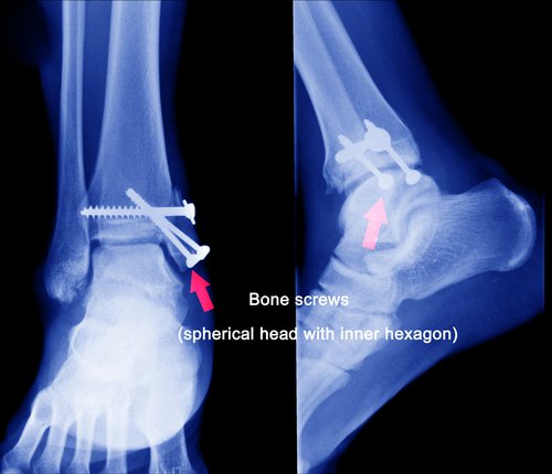 Ankle Fracture - Carolina Regional Orthopedics