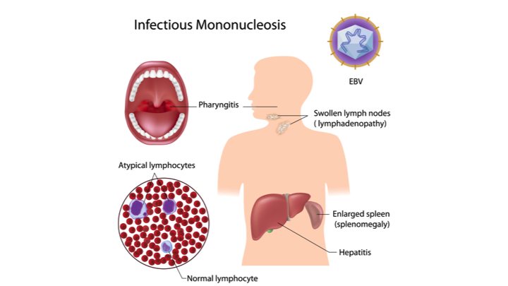 unique-ebv-blood-test-results-r-mononucleosis