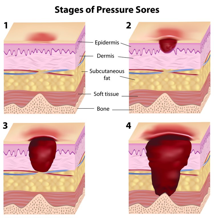 pressure-sores