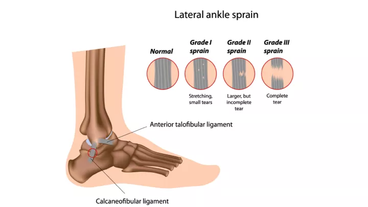 Is it a Sprain, Strain, or Tear? - New York Bone & Joint Specialists