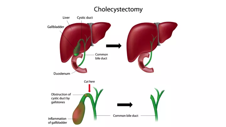 Gallbladder Removal by Laparoscopy (Laparoscopic Cholecystectomy) - DoveMed