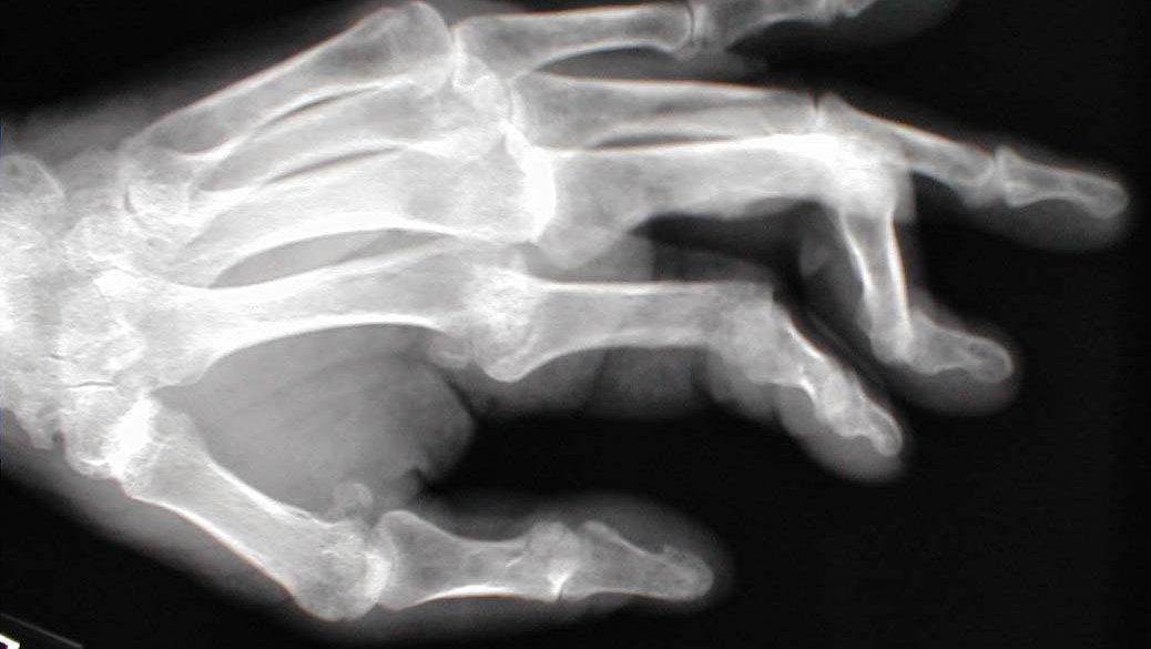 How well do you know Boutonnière Deformity