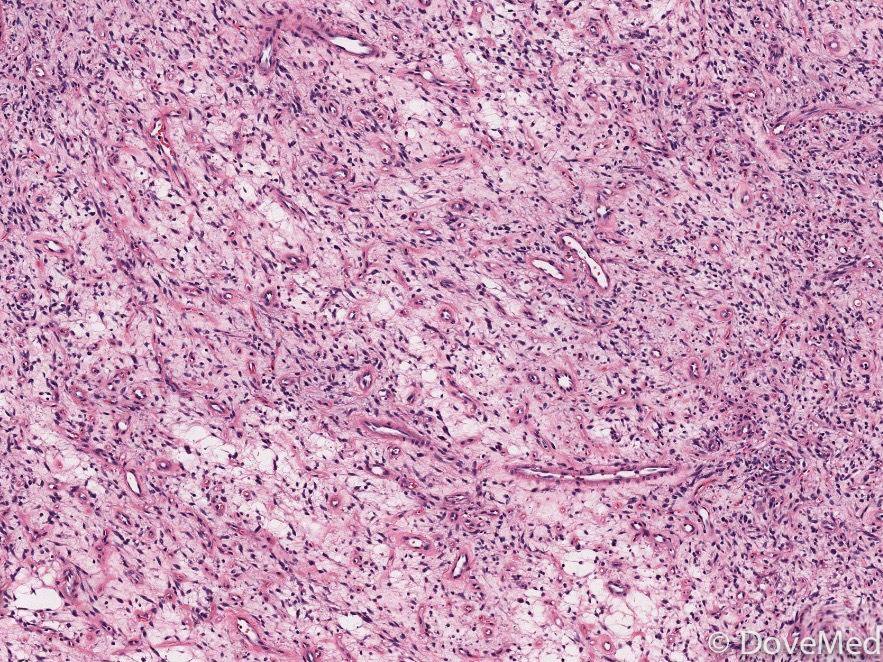 Solitary Fibrous Tumor of Nasal Cavity and Paranasal Sinus