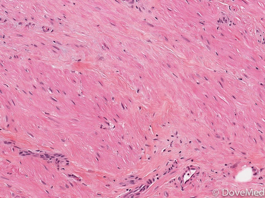 Angiomyolipoma of Oral Cavity