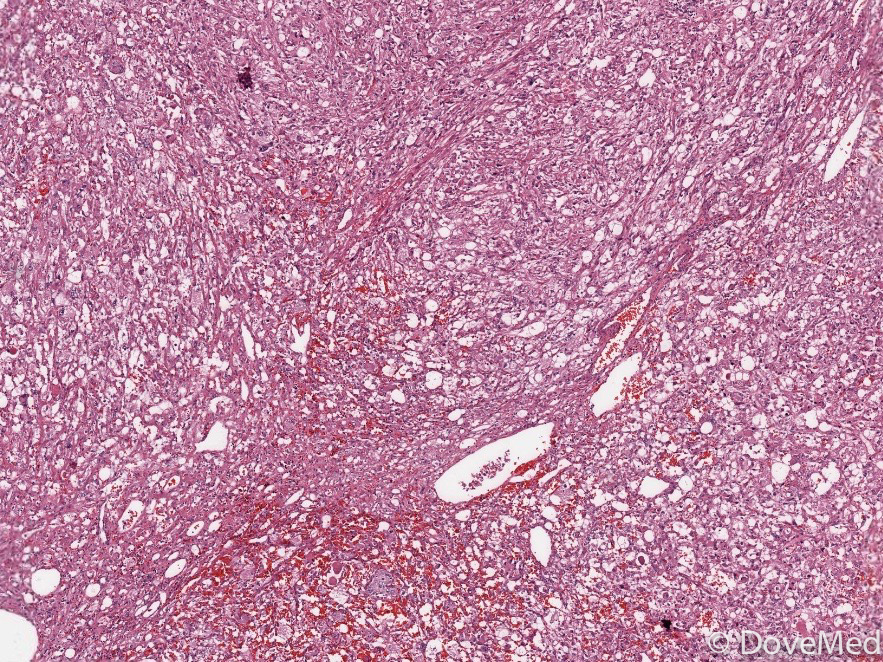 Angiomyolipoma of Bone