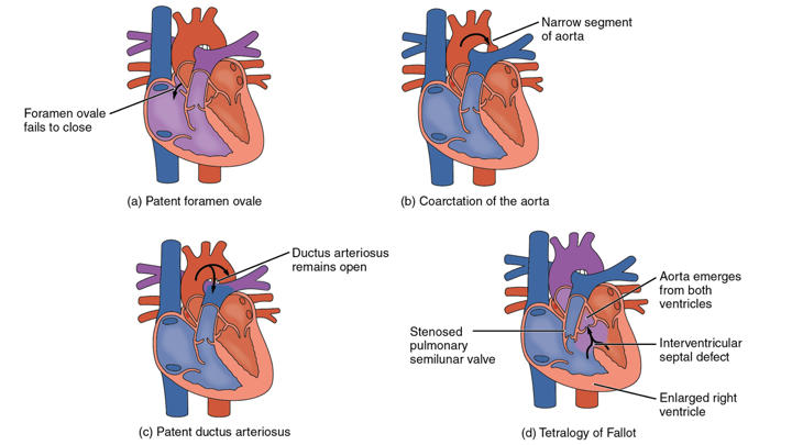 Congenital Heart Defects