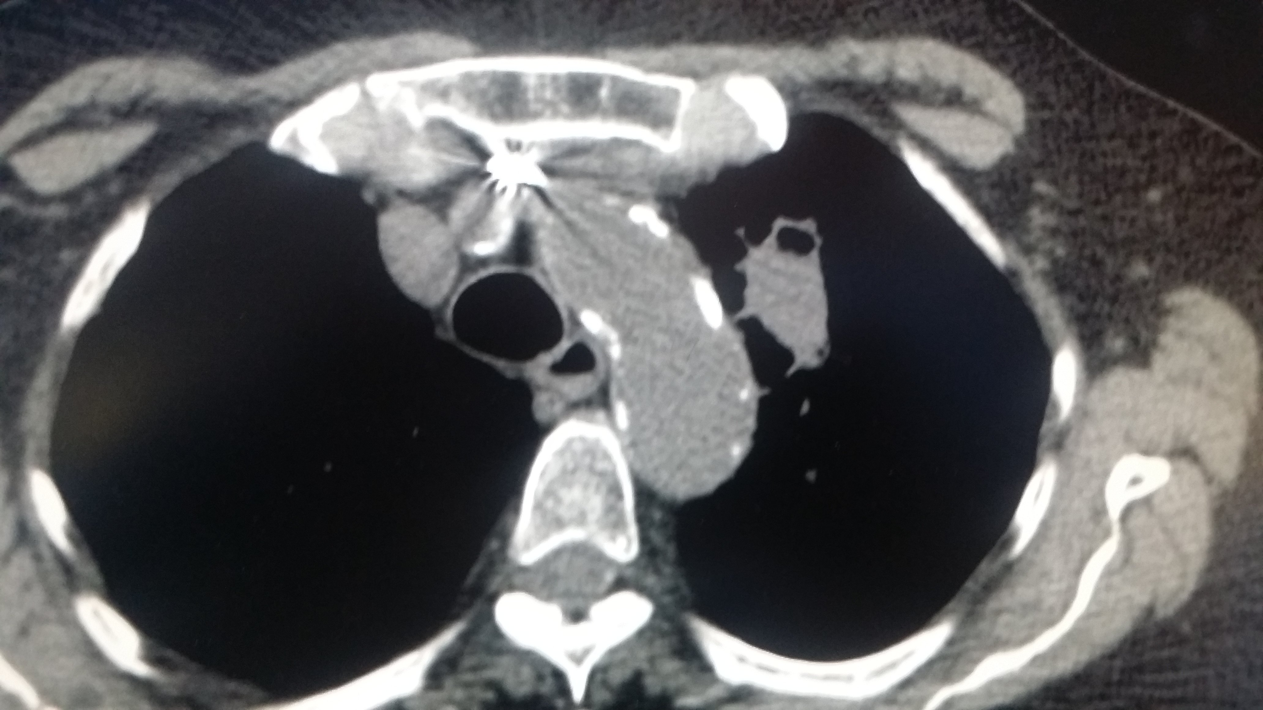 Small Cell Lung Cancer 1613