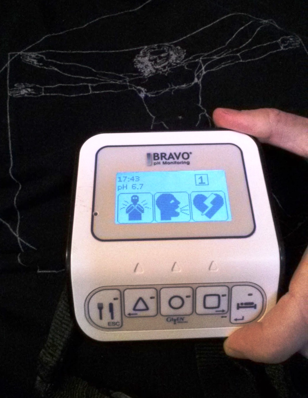 Ambulatory 24 hour Esophageal pH Monitoring