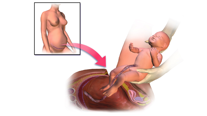 Cesarean Section - Stanford Medicine Children's Health