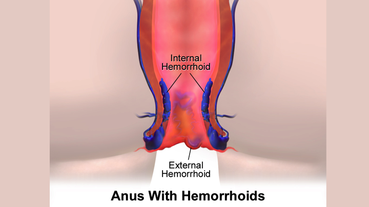 Learn in-depth information on Hemorrhoidectomy, its risks, benefits, complications, cost, recent advances, blood loss, and post-op care at home.