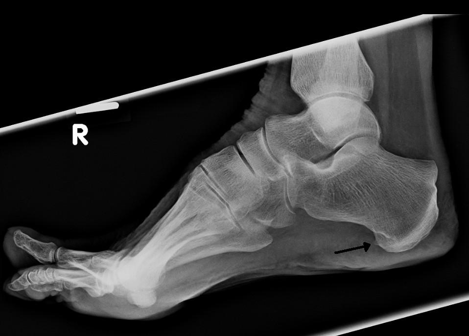 tarsal boss bone spur