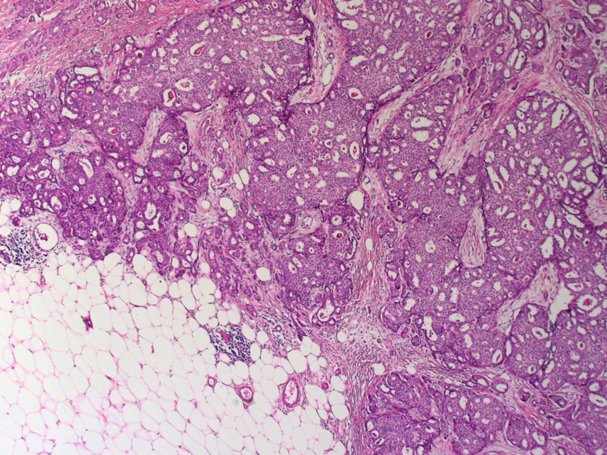 invasive-cribriform-carcinoma-of-breast