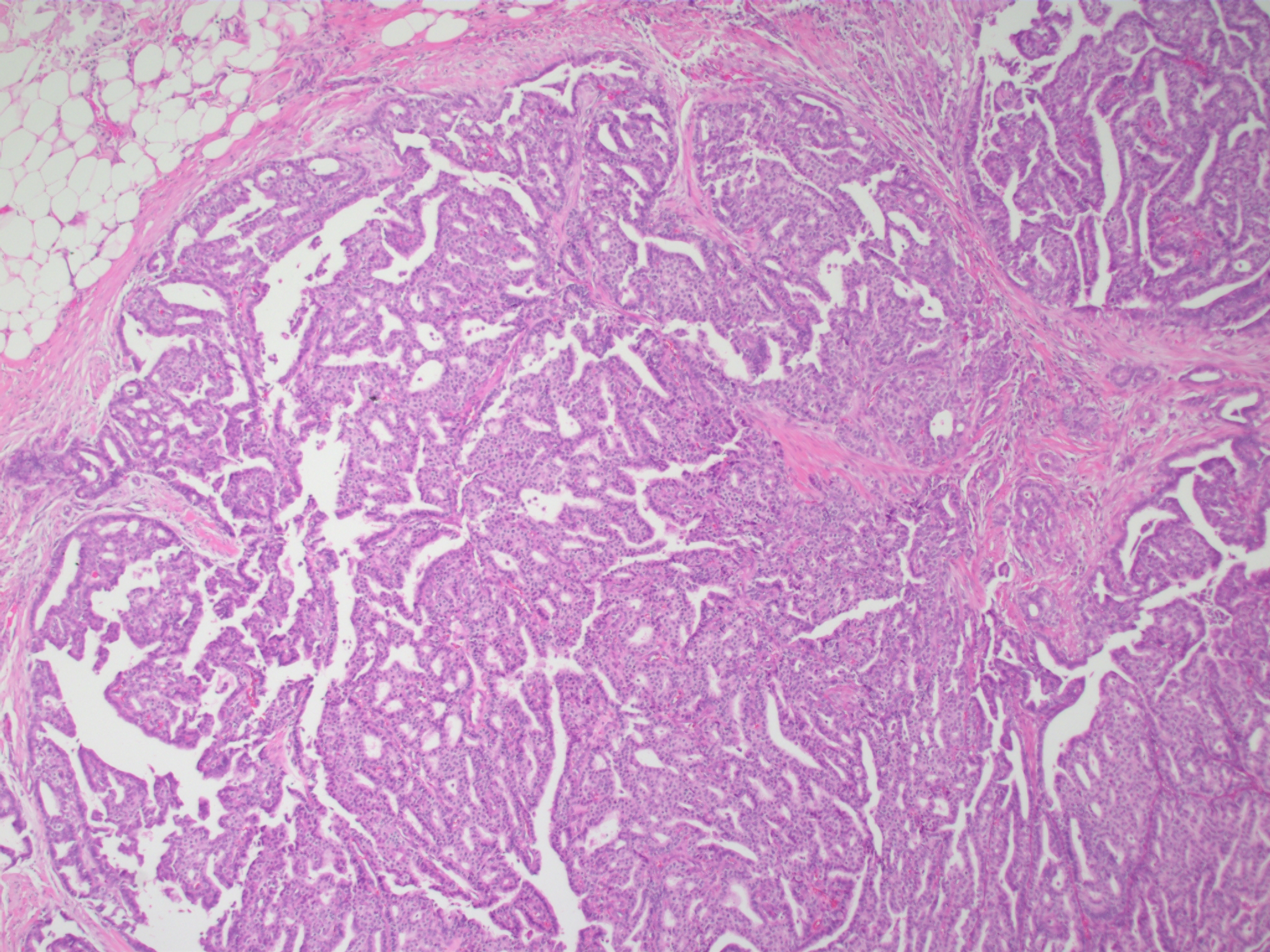 Papillary Carcinoma