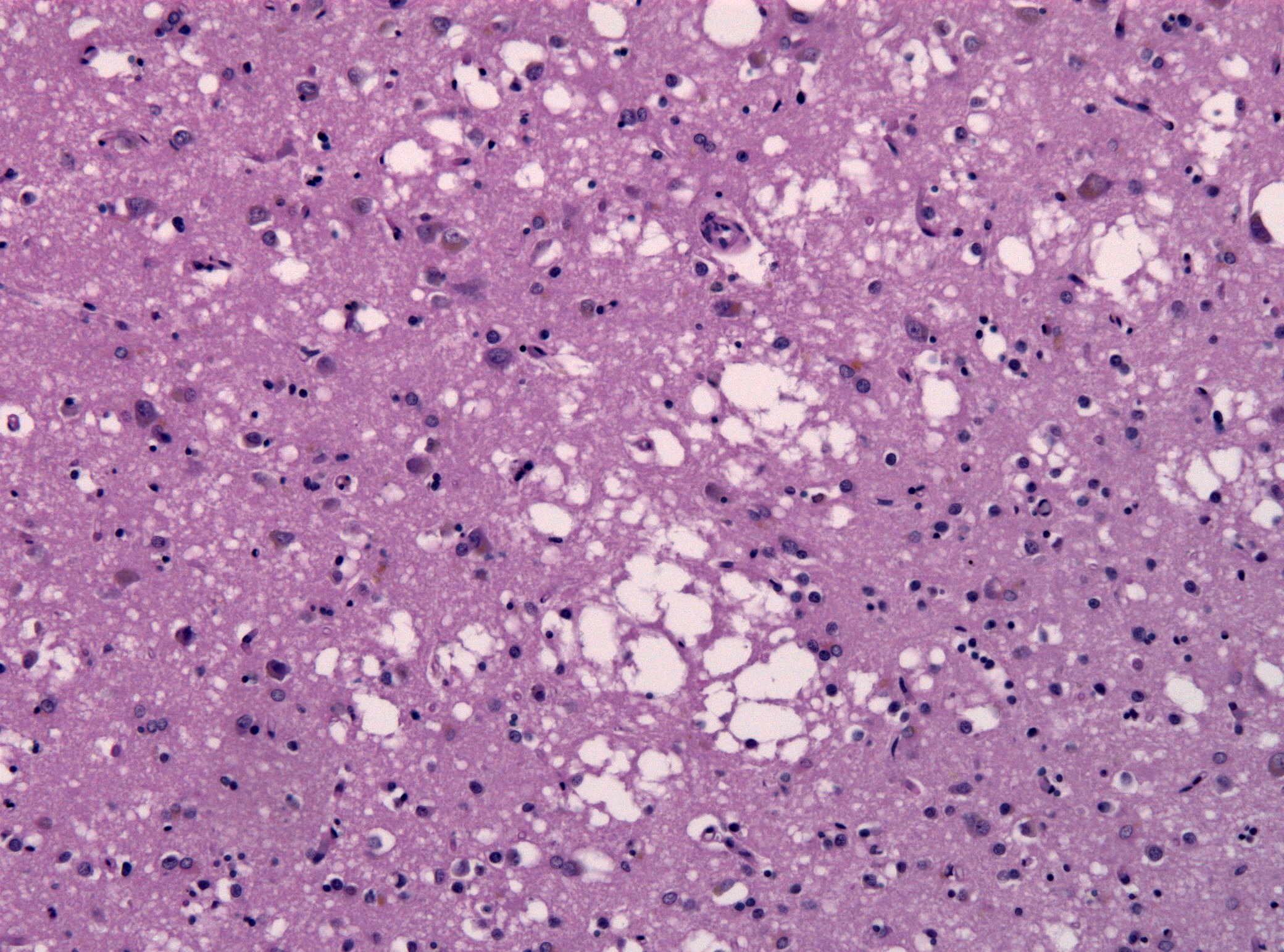 Creutzfeldt-Jakob Disease (CJD)