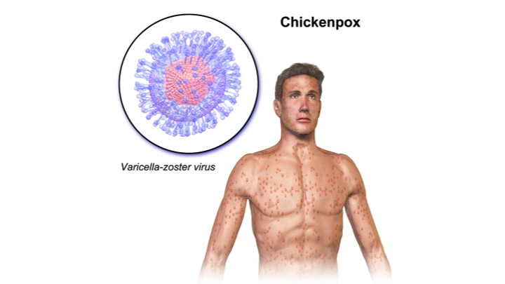 Chickenpox Infection