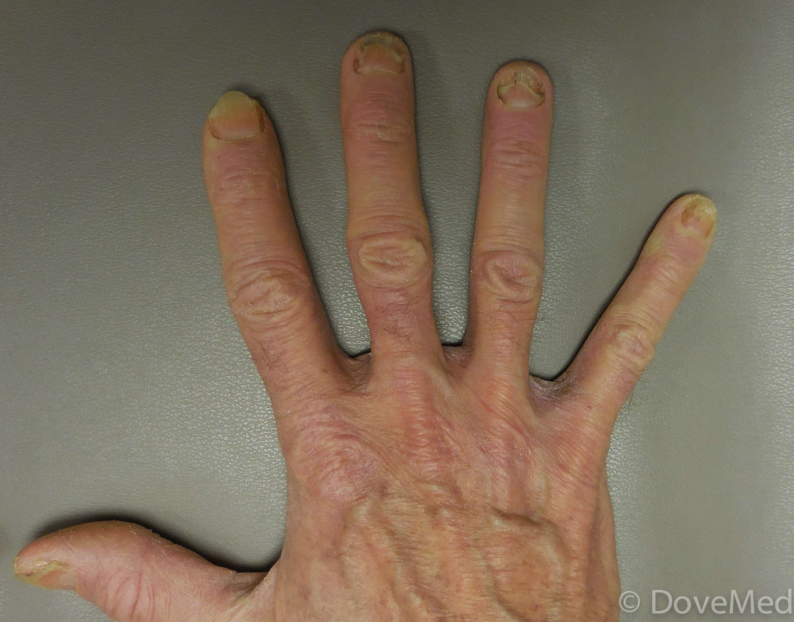 Ringworm - tinea manuum on the finger: MedlinePlus Medical Encyclopedia  Image