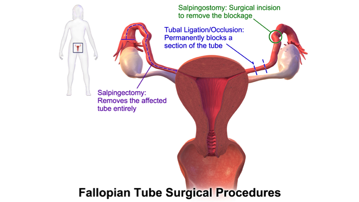 tubal-blockage-causes-symptoms-treatments-our-approach