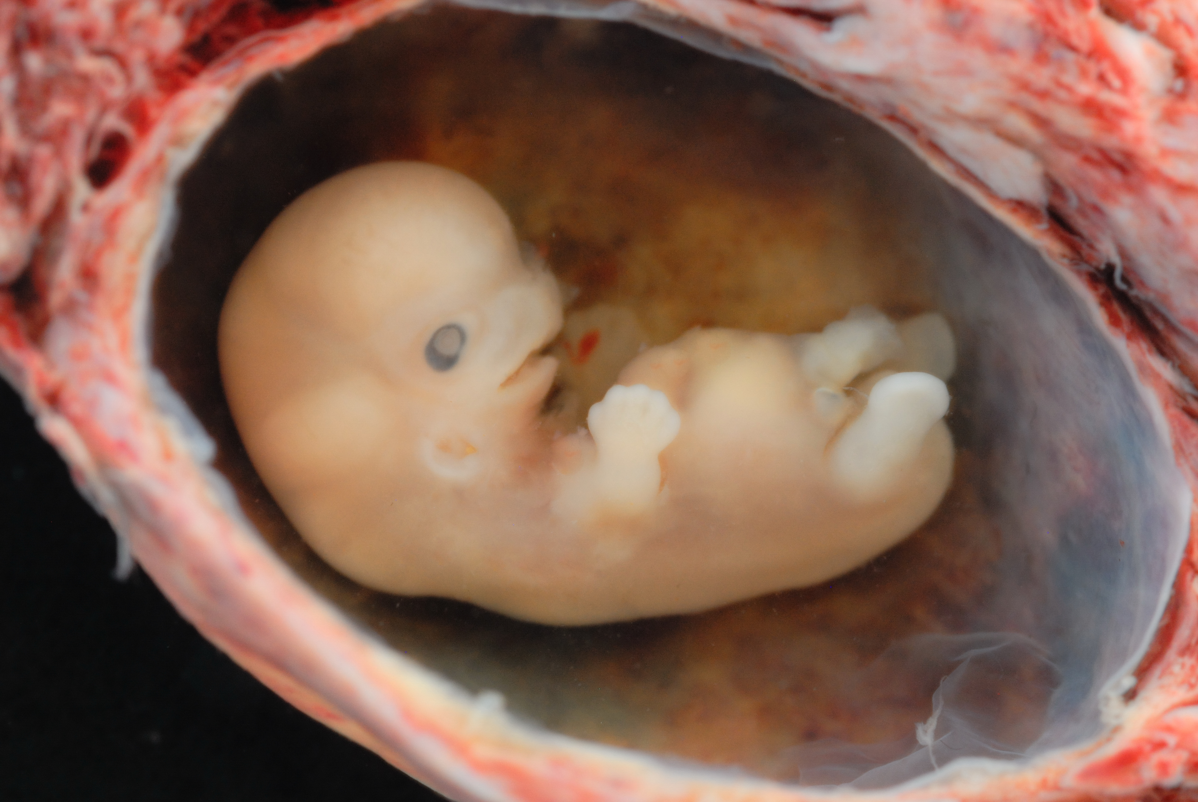 miscarried embryo at 3 weeks