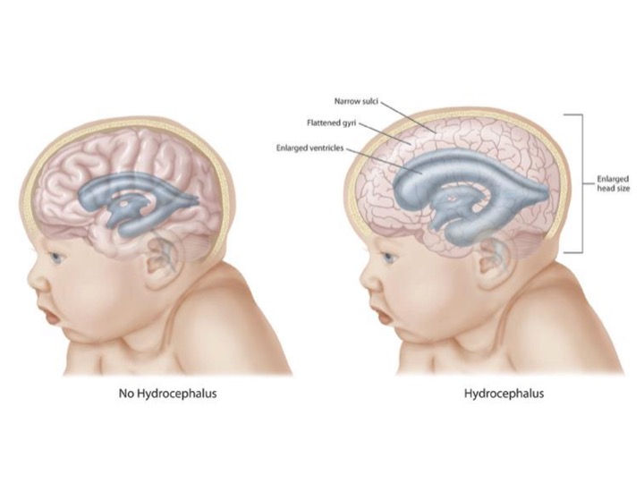 hydrocephalus in children