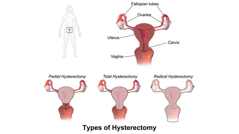 Hysterectomy Abdominal With Salpingo Oophorectomy