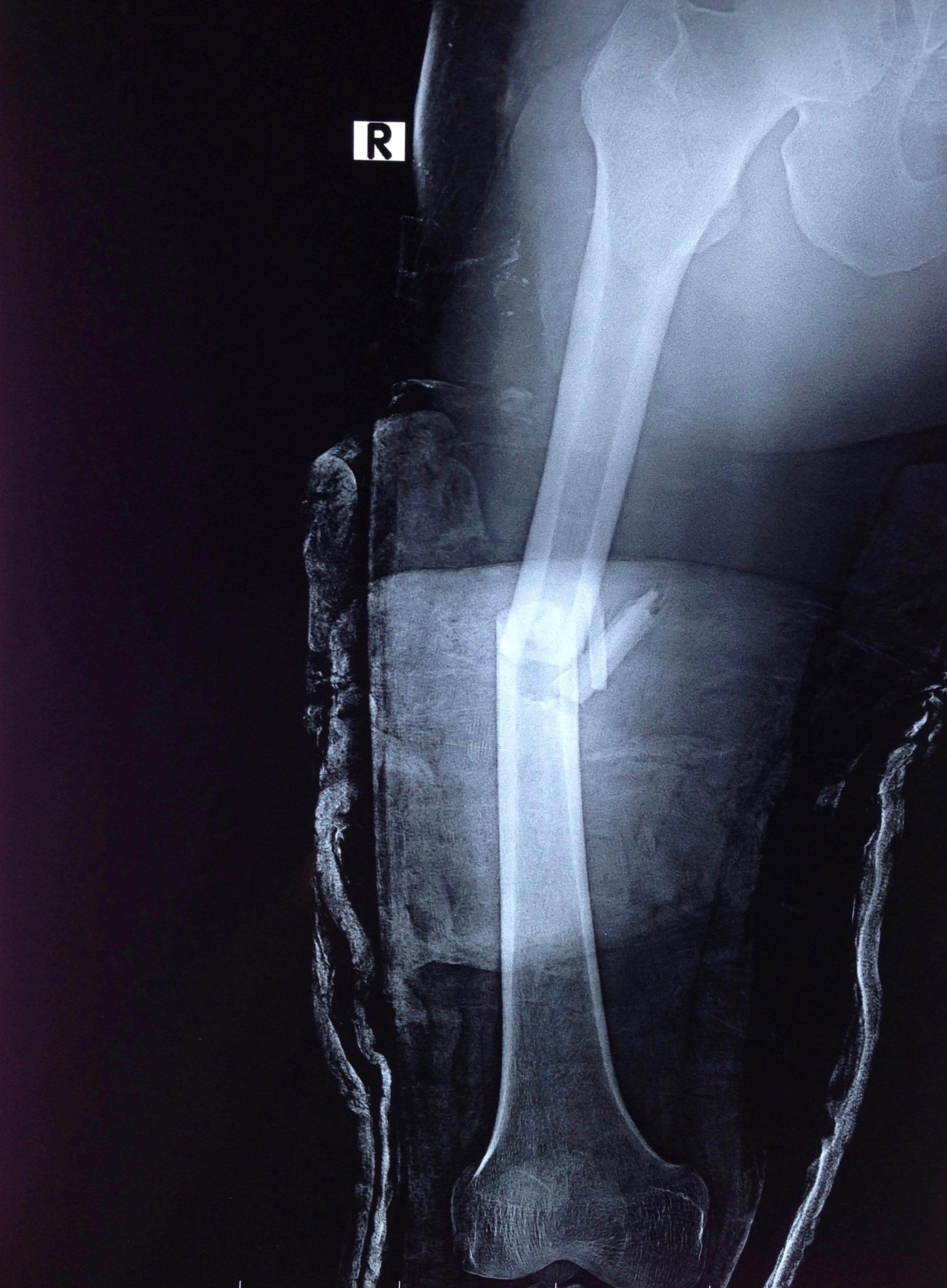 Foto Stock Types Of Bone Fractures Femoral Shaft Fracture Adobe Stock