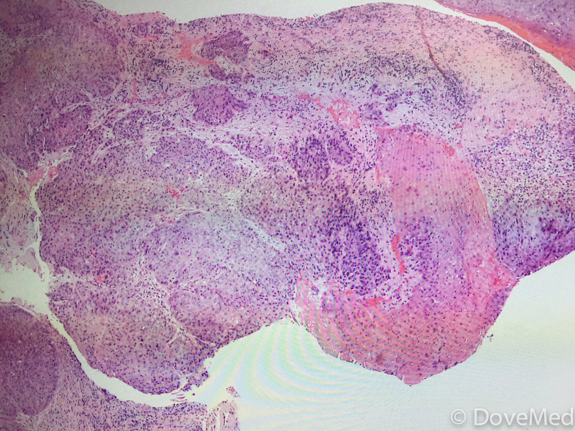 squamous-cell-carcinoma-of-tongue