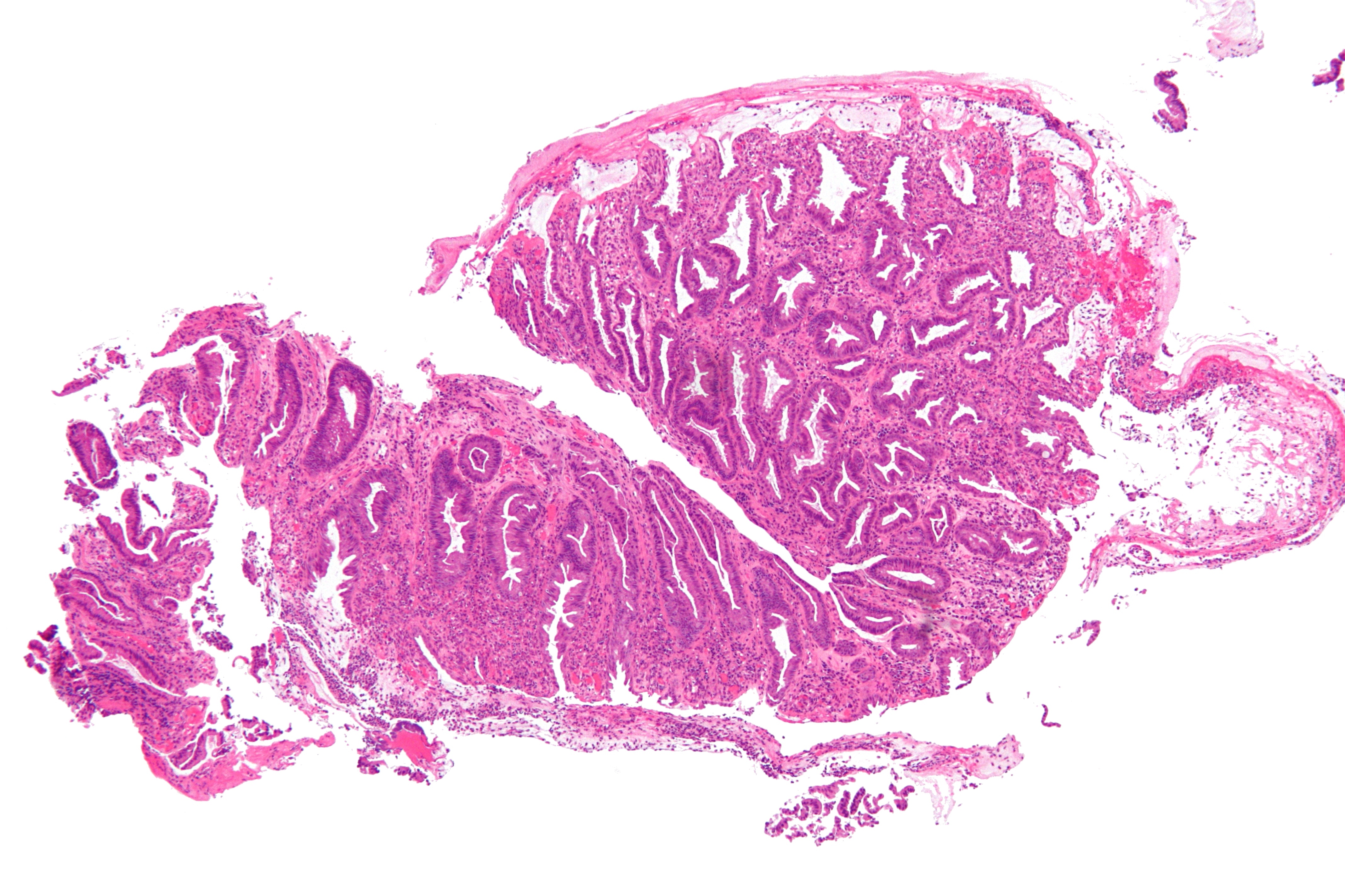 Ischemic Colitis