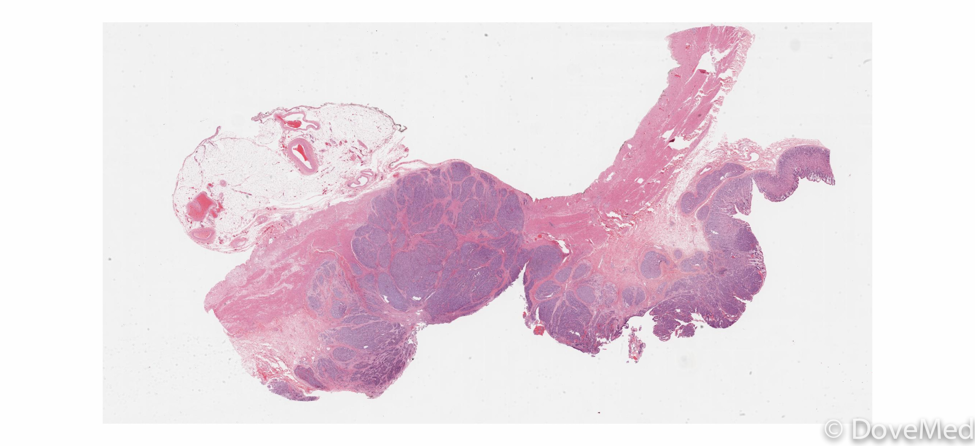 large-cell-neuroendocrine-carcinoma-of-the-urinary-bladder