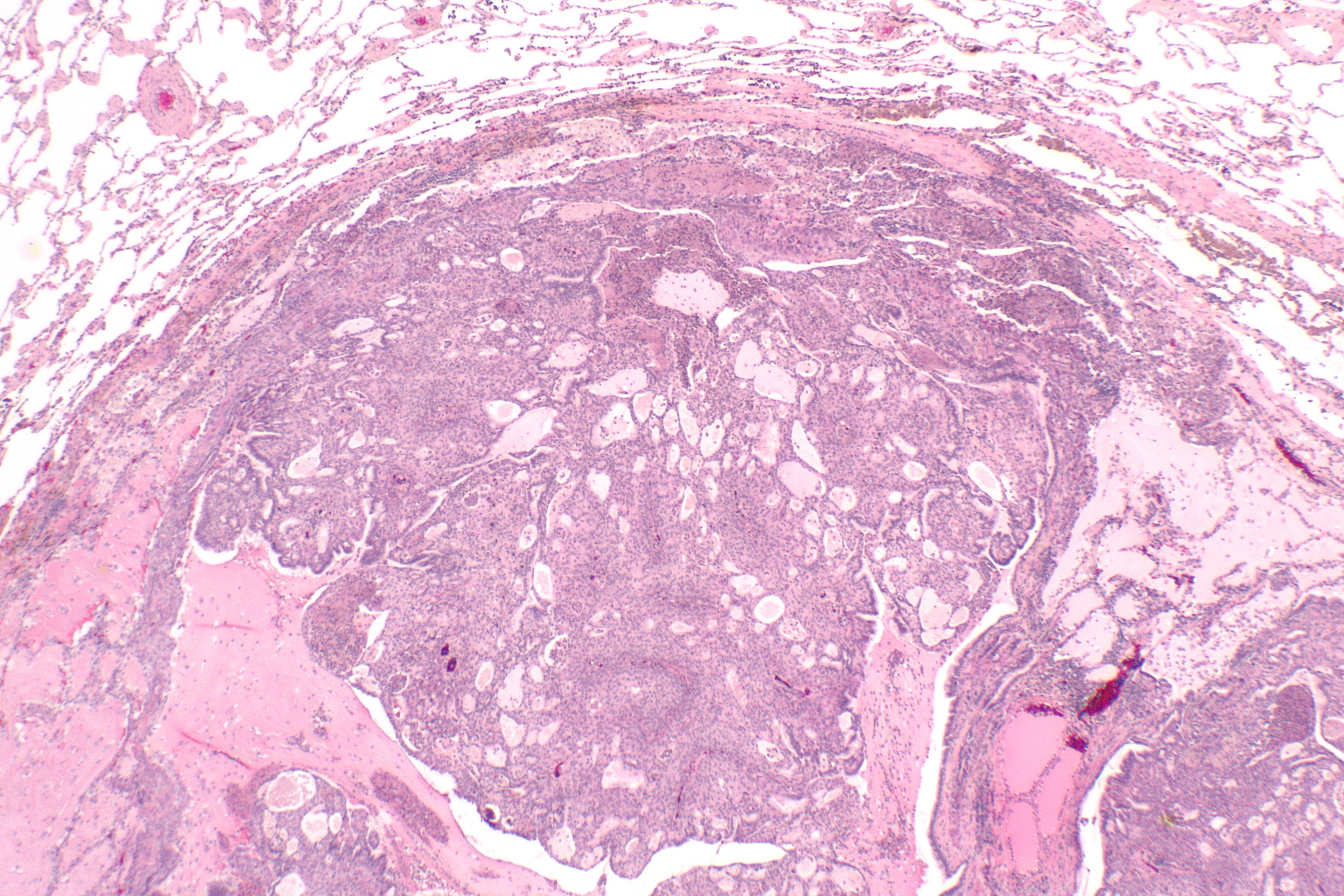 solitary glandular papilloma of the lung