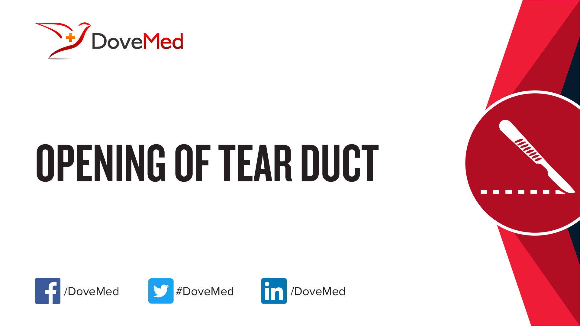 opening-of-tear-duct