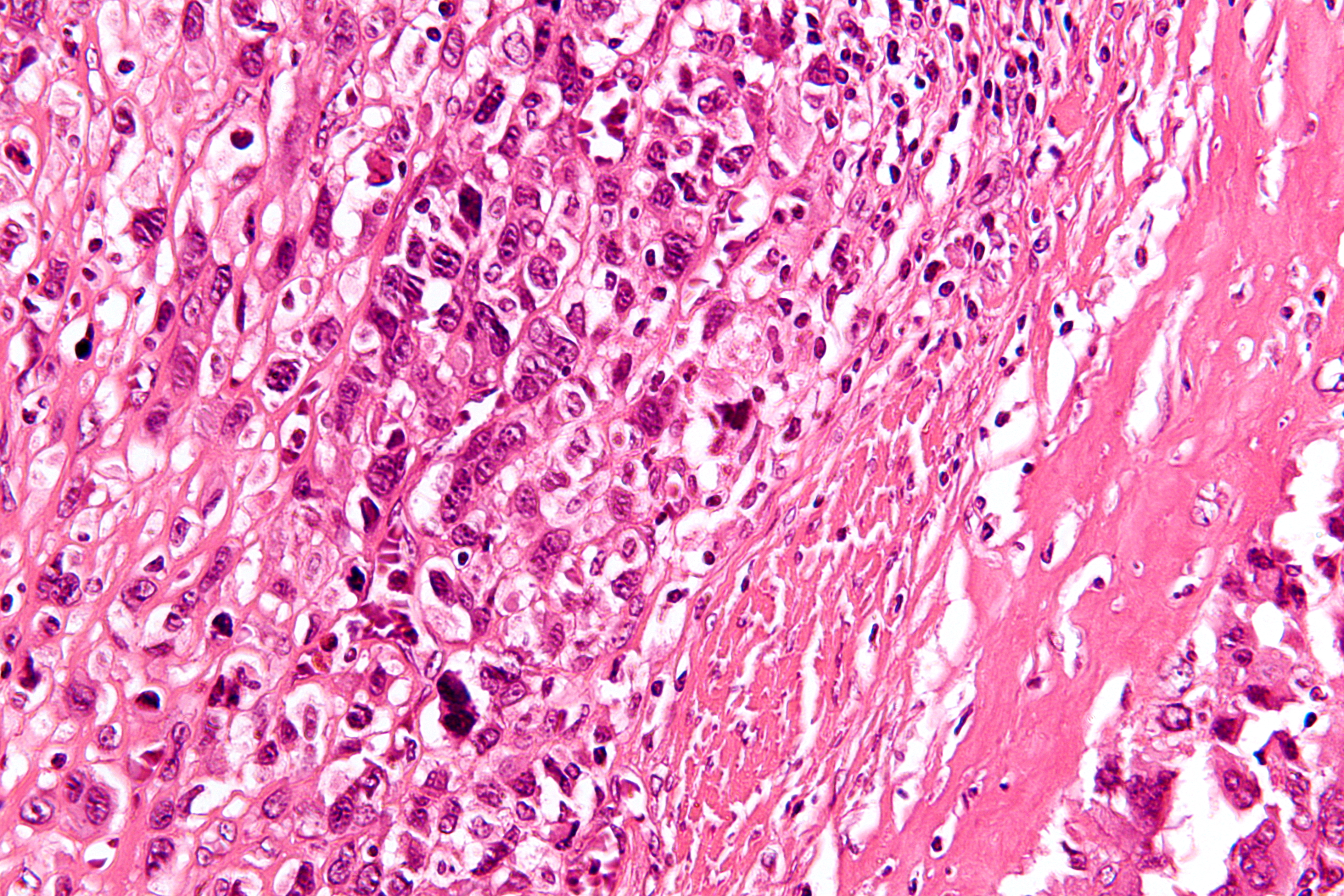 Multicentric Osteosarcoma