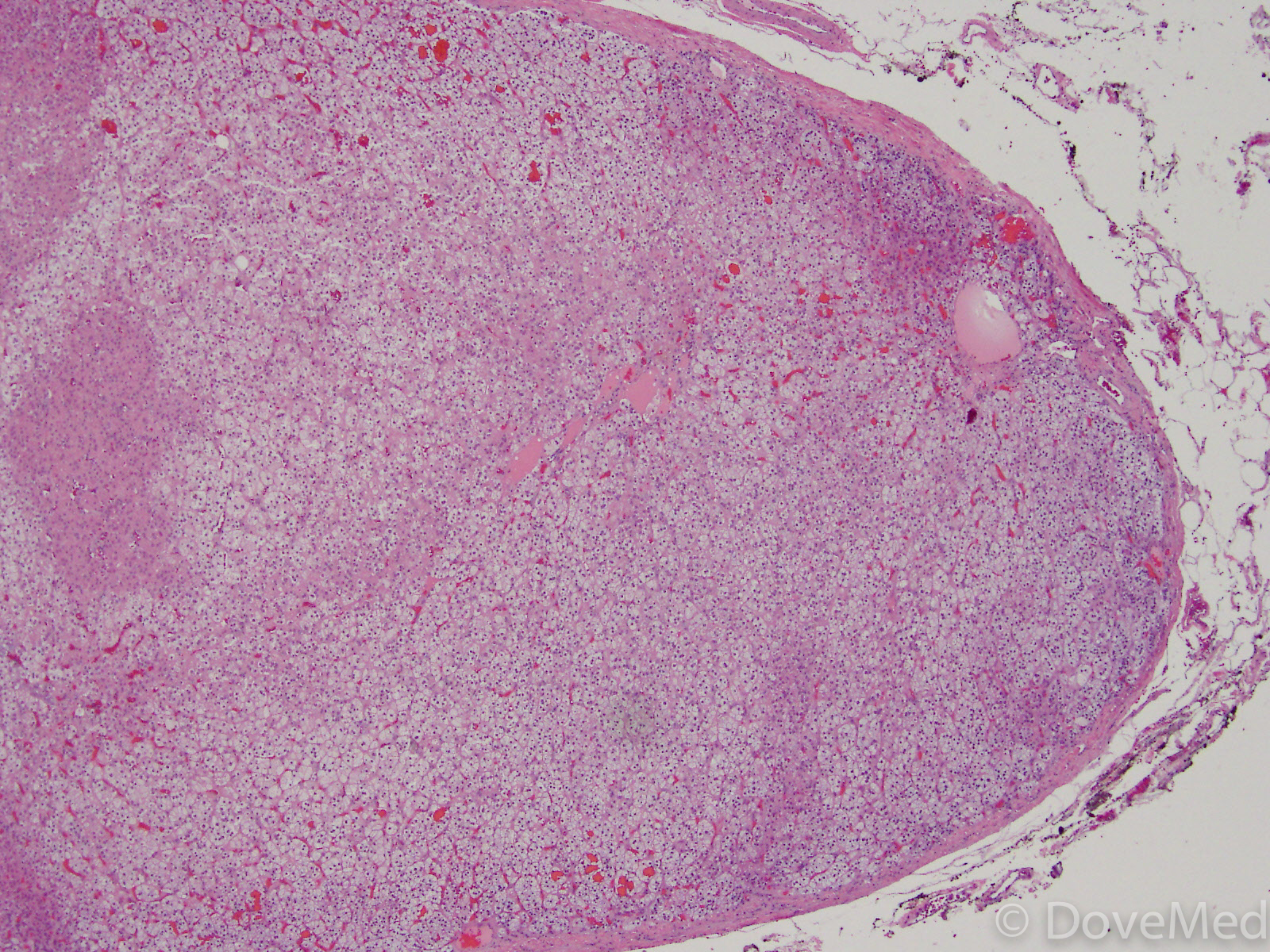 Adrenal Gland Needle Biopsy