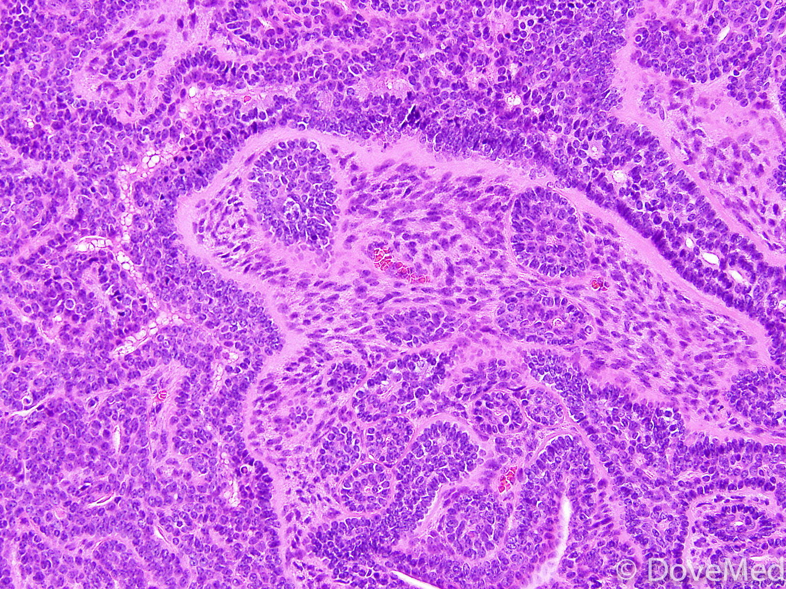 Basal Cell Adenoma Of Salivary Gland 5240