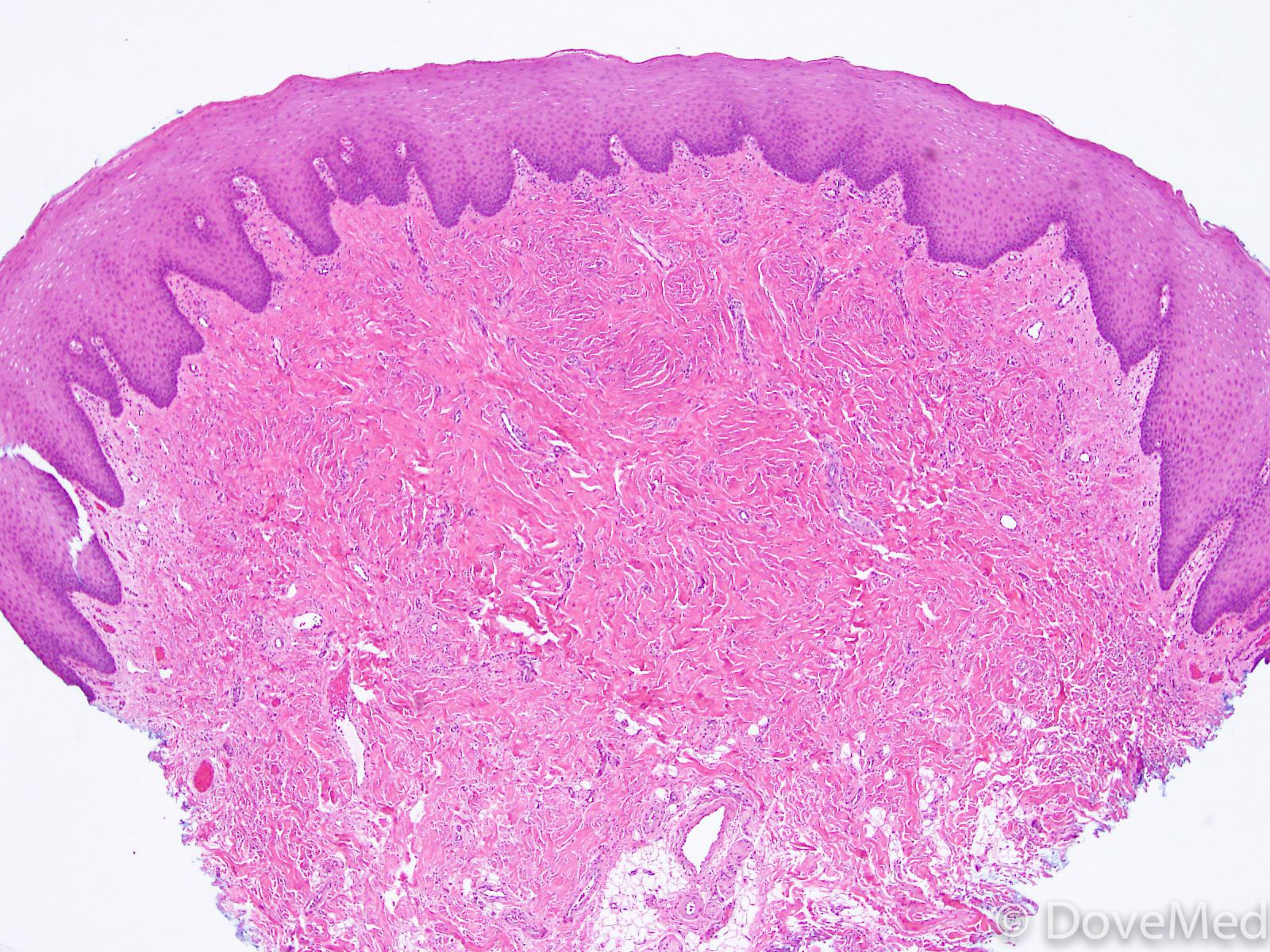 irritation fibroma histology