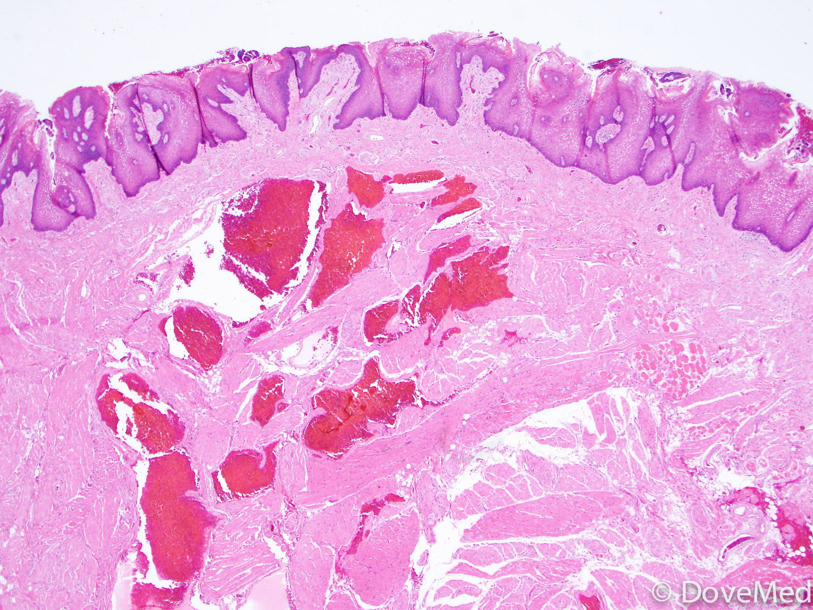 tongue-biopsy