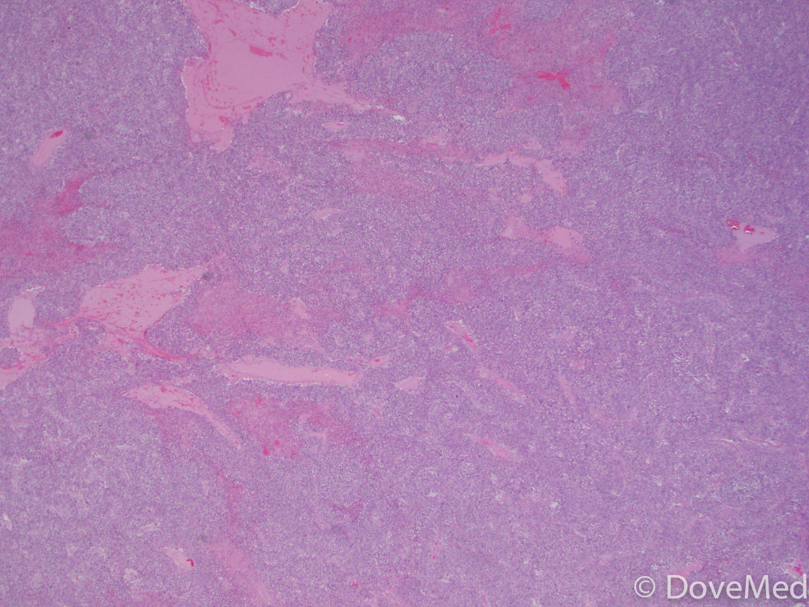 leiomyosarcoma-of-the-genitourinary-system